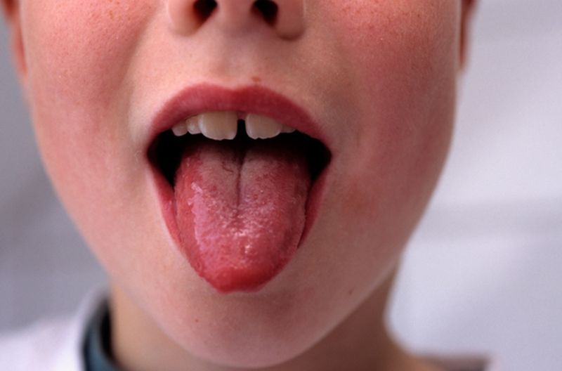 La microbiota oral de los niños podría predecir la obesidad