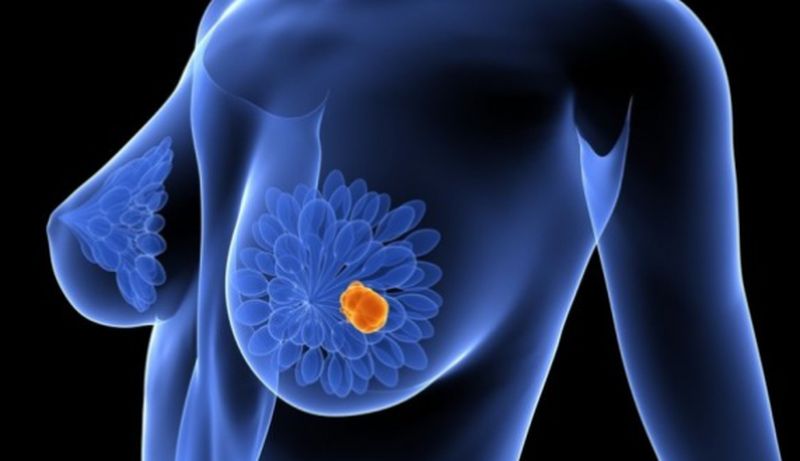 Una dieta baja en grasa reduce el riesgo de muerte por cáncer de mama en postmenopáusicas