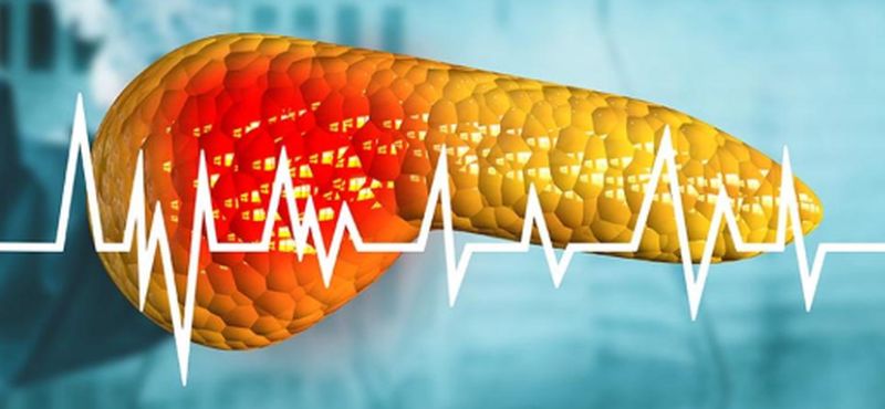 La diabetes tipo 3c es una manifestación temprana del cáncer de páncreas