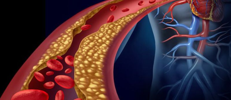 Los altos niveles de triglicéridos y colesterol incrementan el riesgo cardiovascular en caso de obesidad