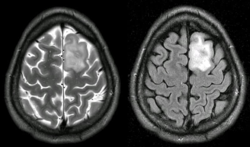 La exposición a un patógeno común transmitido por alimentos podría estar relacionada con un tipo de cáncer cerebral