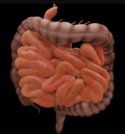 Manejo de la diverticulitis colónica