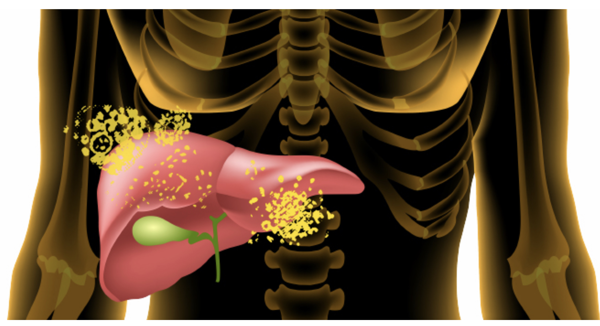 Efecto del ayuno en días alternos combinado con ejercicio aeróbico en la enfermedad del hígado graso no alcohólico.