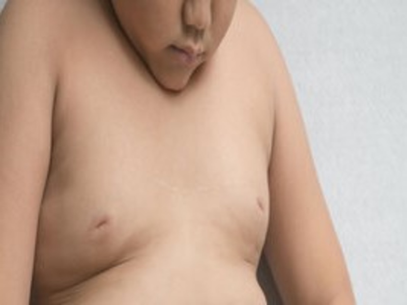 ¿Por qué el hígado graso está afectando a más niños, cuando era sólo una enfermedad de adultos?