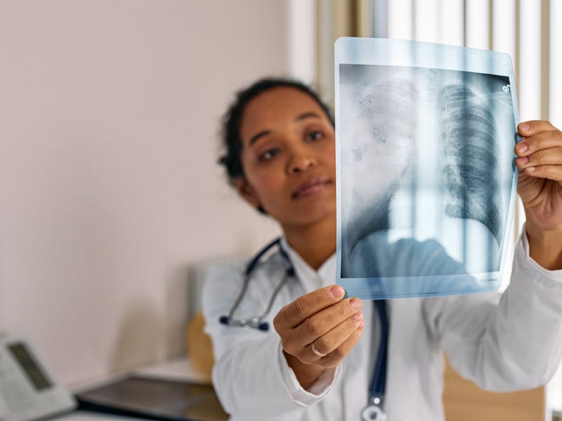 Deficiencia de vitamina D asociada a mayor mortalidad en neumonía